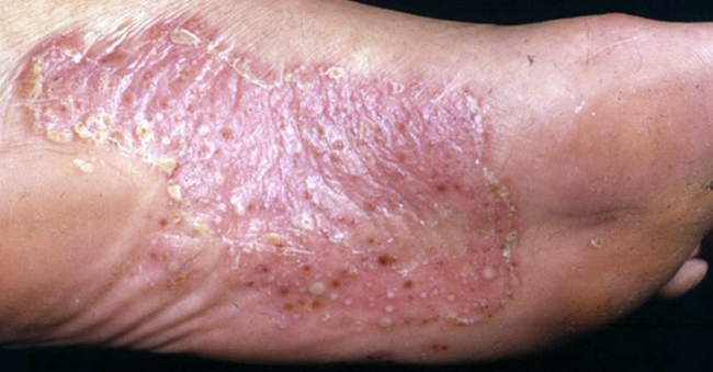 Palmoplantar Psoriasis