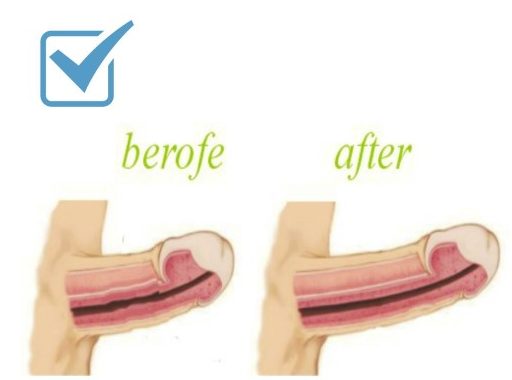penis enlargement by fillers