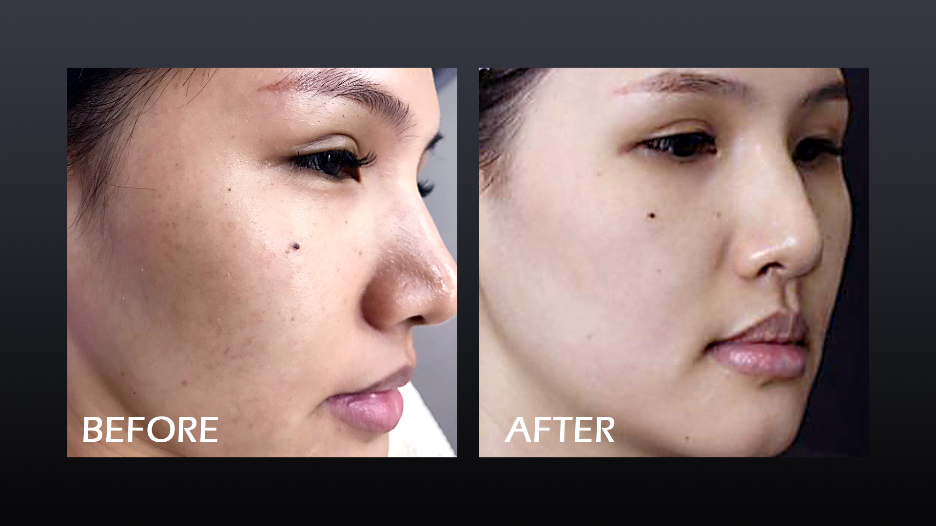 Pico Laser 02 Before After
