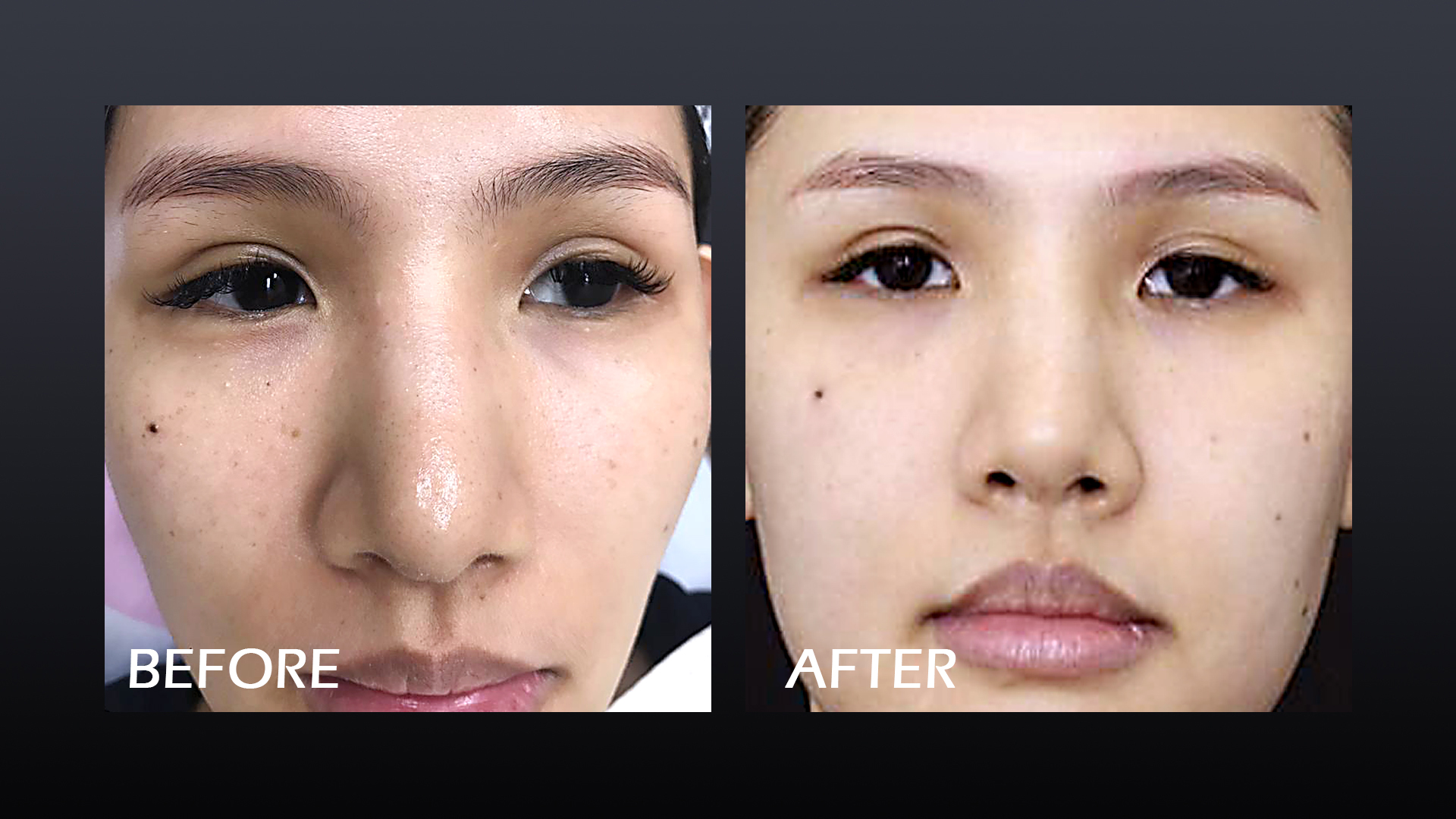 Pico Laser 02 Before After