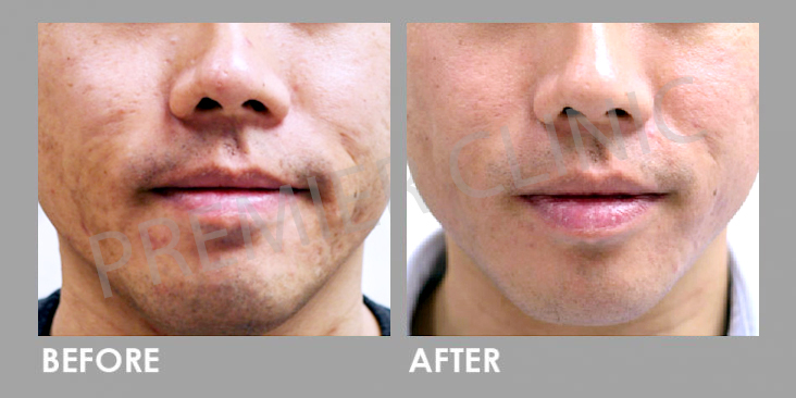 Pico Laser Before After