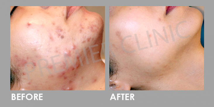 Pico Laser Before After