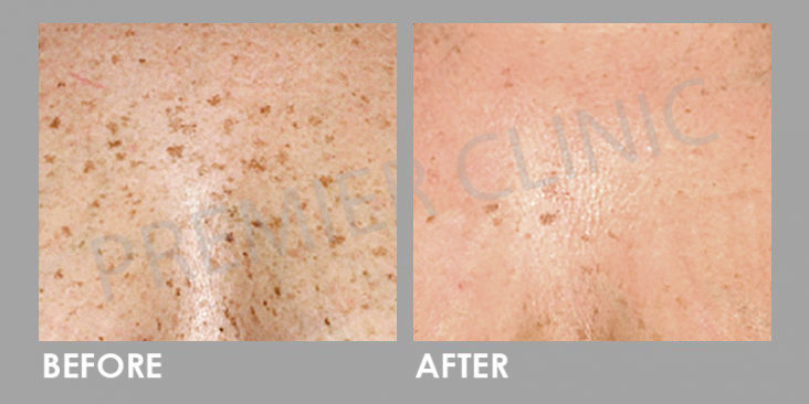 Pico Laser Before After