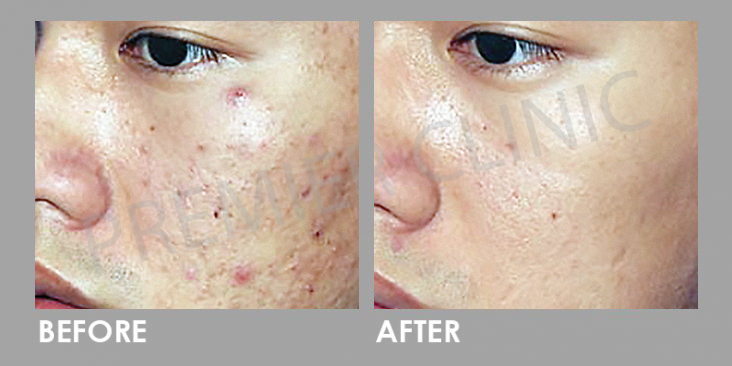 Pico Laser Before After