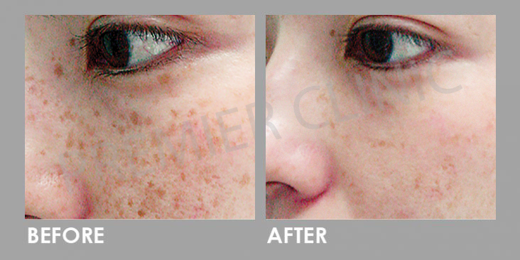 Pico Laser Before After
