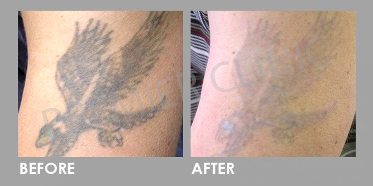 Pico Laser Before After