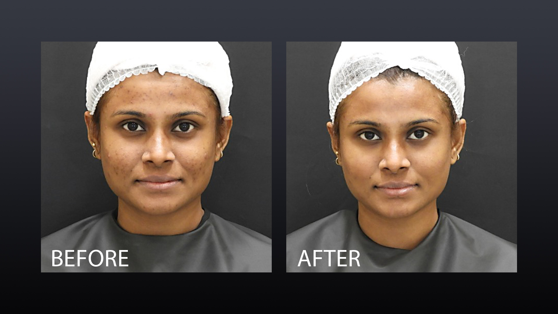 Pico Laser Before After 