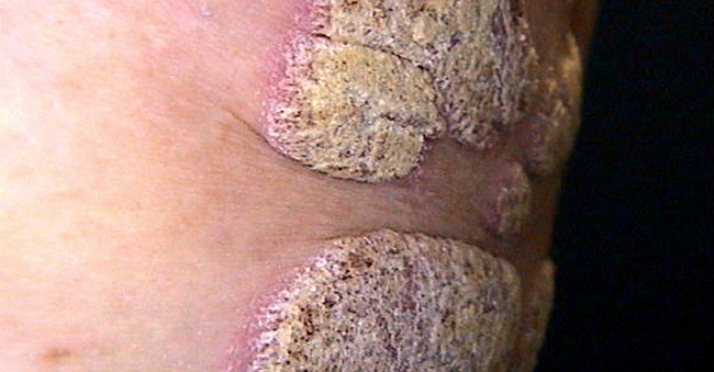 Plaque psoriasis