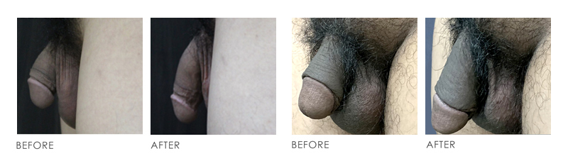 Premier Clinic Penis Enlargement Before After 01