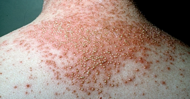 Pustular Psoriasis
