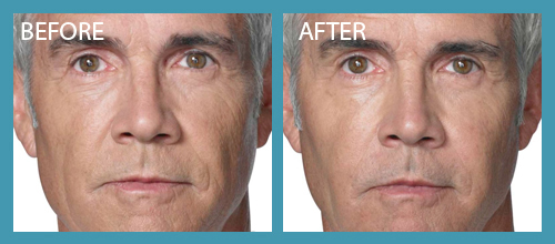 Radiesse Filller Before After Premier Clinic 04