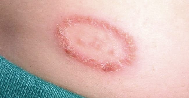 Ringworm