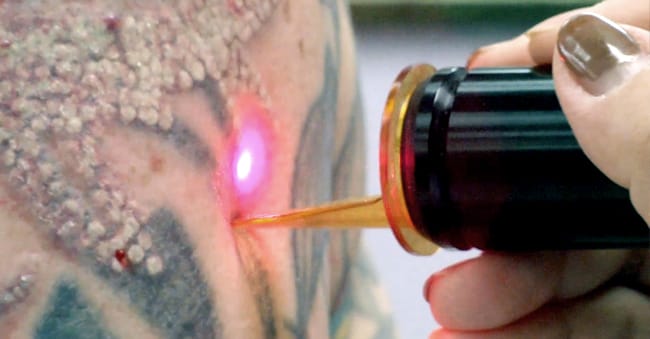 Risks of Removing Tattoos