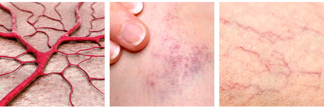Ruptured & Broken Capillaries