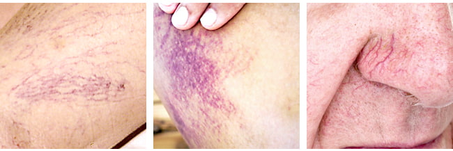 Ruptured & Broken Capillaries