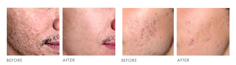 SKIN RESURFACING Before After