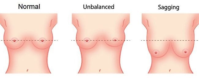 Saggy breasts