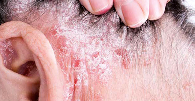 Scalp Psoriasis
