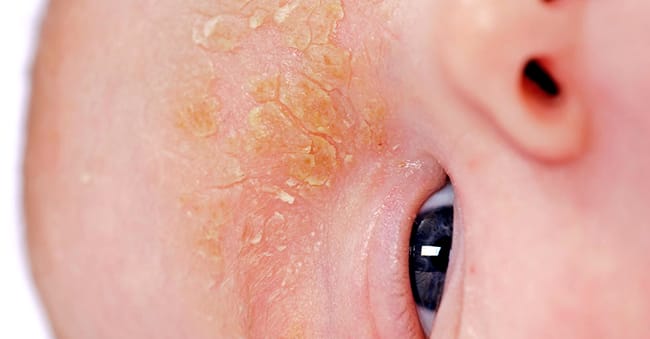 Seborrheic dermatitis