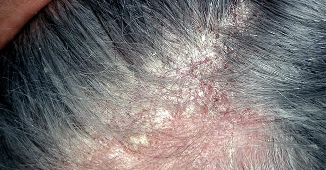 Seborrheic eczema