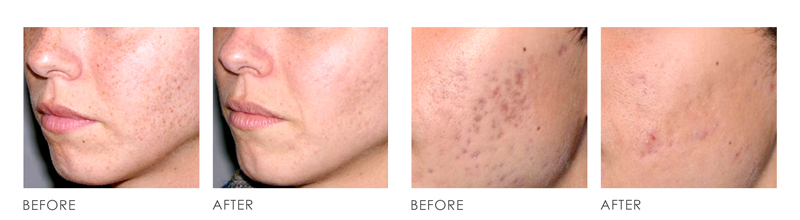 SkinLaser Before After
