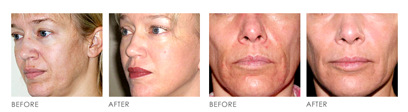 Stem Cell Before After