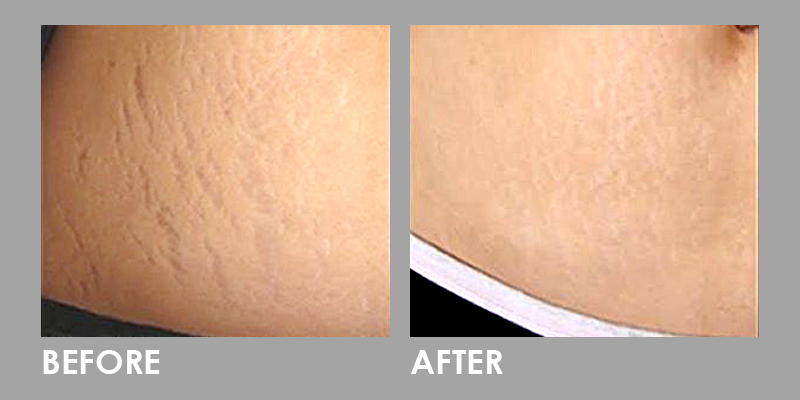 Stretch Marks