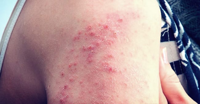 Symptoms in adults