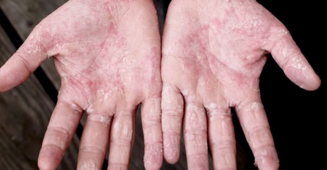 Symptoms in children aged 2 years old and above