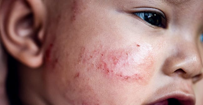 Symptoms in infants under 2 years-old