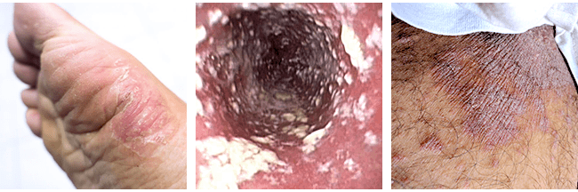 Symptoms of a Fungal Infection