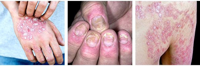 The Symptoms of Psoriasis