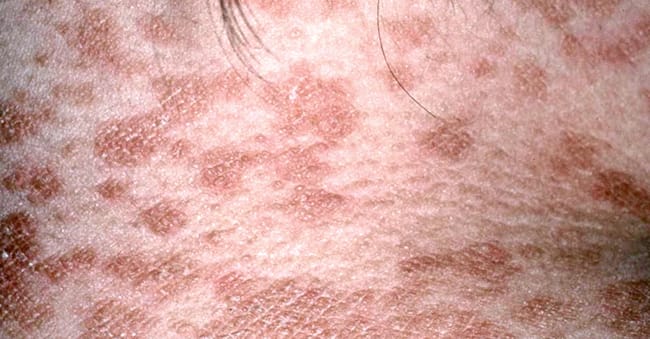 Tinea Versicolor