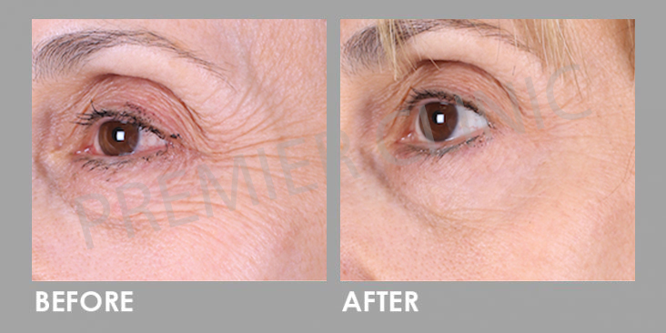 Ultherapy Before After
