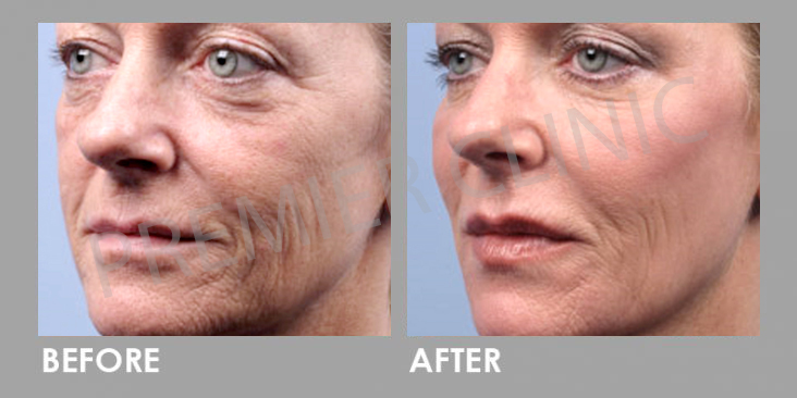 Ultherapy Before After