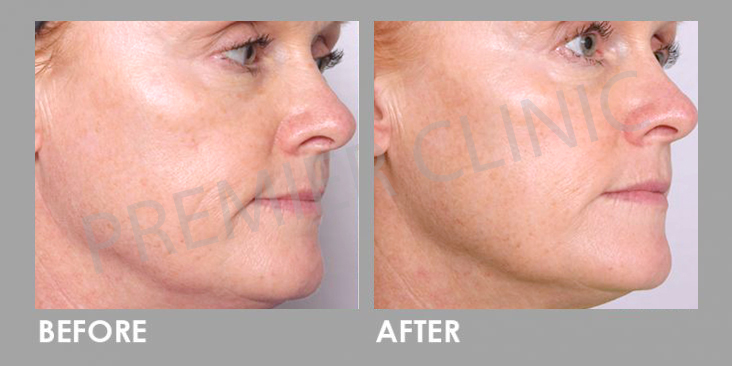 Ultherapy Before After
