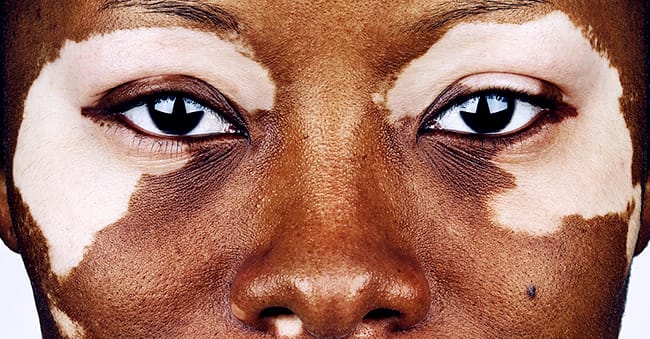 Vitiligo