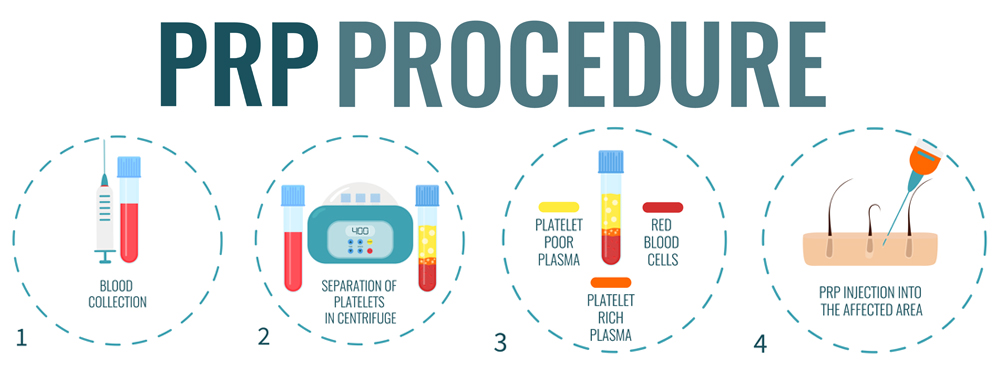 Plasma-Rich Platelets treatment