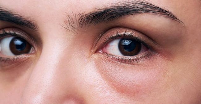What Is Eye Bags