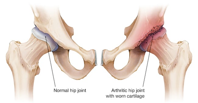What Is Osteoarthritis