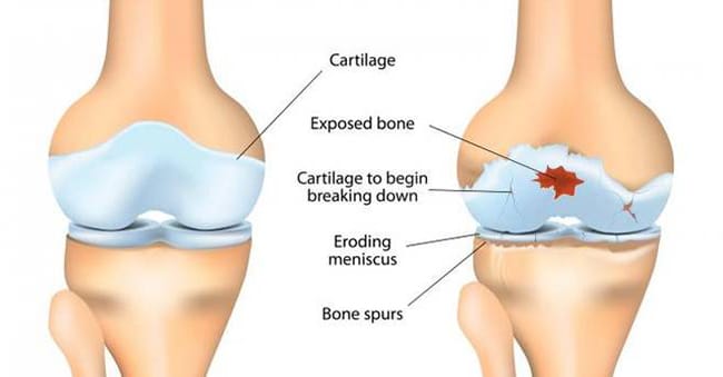 What Is Osteoarthritis
