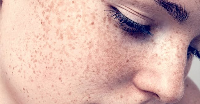 What Is Pigmentation