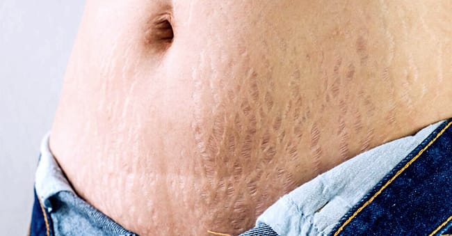 What are Stretch Marks