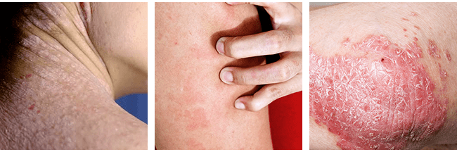 What is Eczema