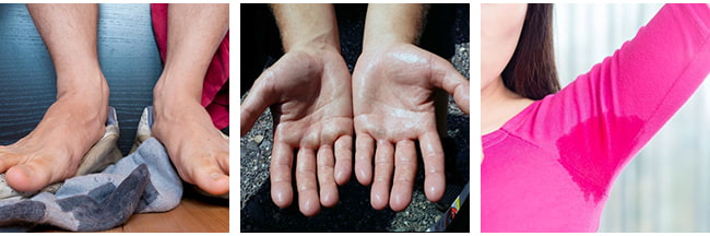 What is Hyperhidrosis or Excessive Sweating