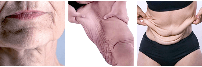 What is Saggy Skin