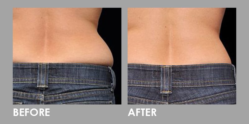 Zeltiq Coolsculpting Cryolipolysis