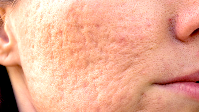 how_to_get_rid_of_acne_scars