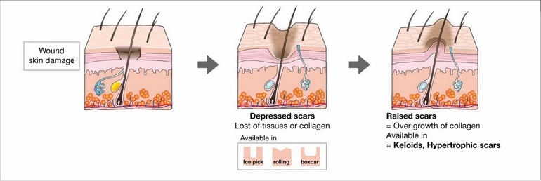 Types Of Acne Scars