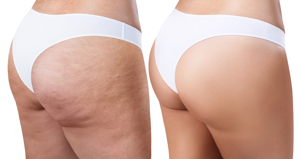 The mesolipo treatment will target localised fat deposits and cellulite
